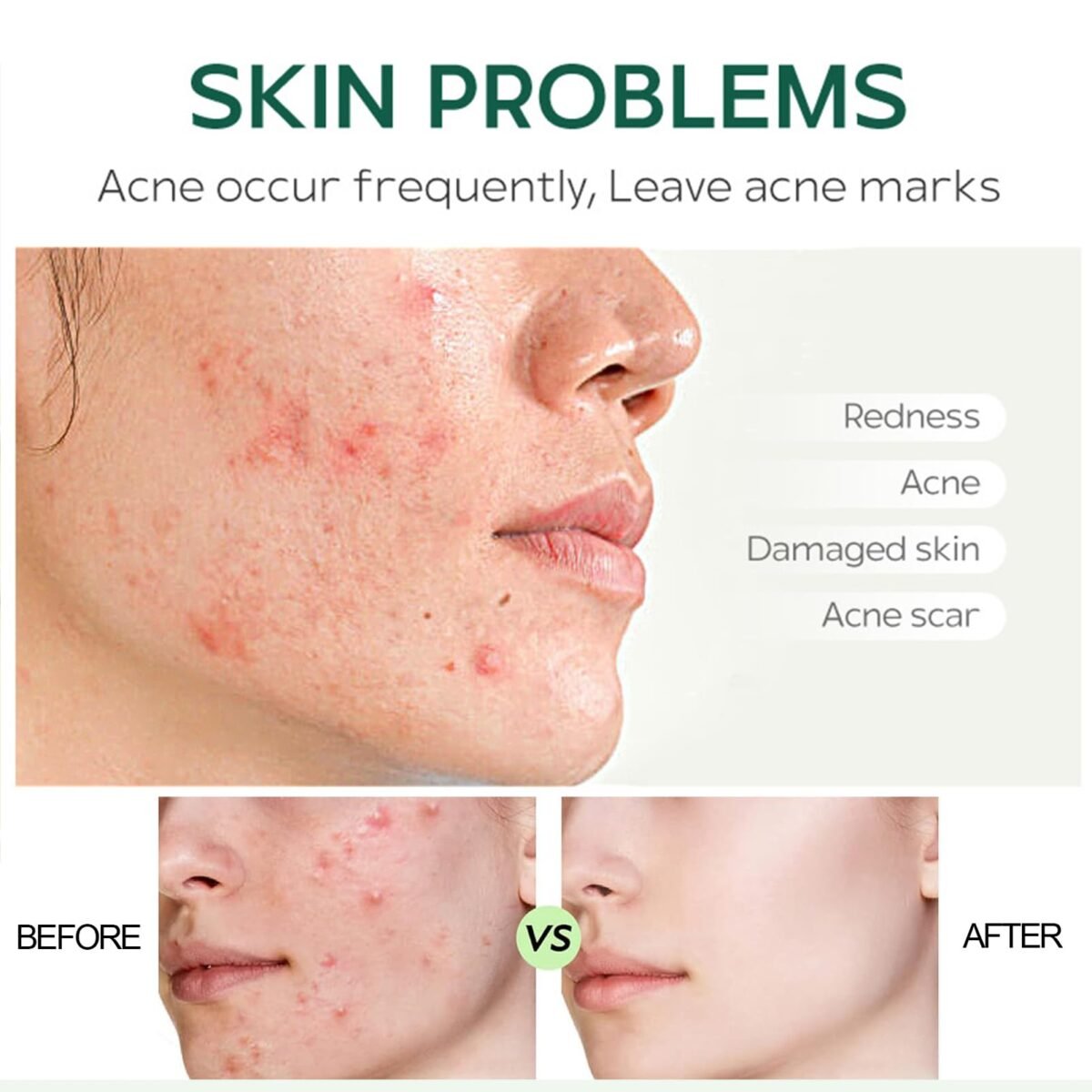 Version 1.0.0 Acne Cream